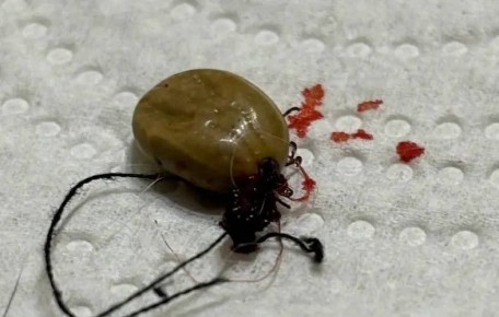 В 2025 году орловчане после укуса клещей заболевали в 2 раза чаще